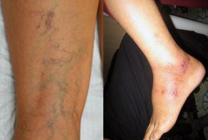 Điều trị suy giãn tĩnh mạch chân hiệu quả